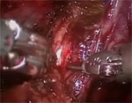 Hydrodissection for preservation of neurovascular bundle during robot-assisted radical prastectomy